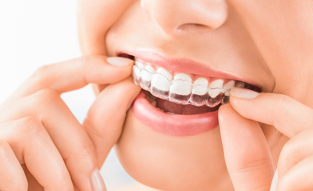 Conseils pour l'entretien de gouttières d'alignement Invisalign